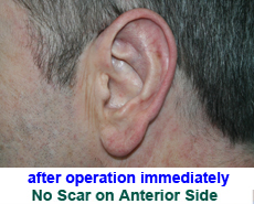 plastic-surgery-prominent-ear 